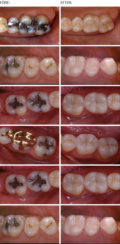 Amalgam Remediation StockholmAstondental