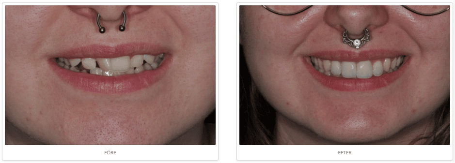 Invisalign-osynlig-tandstallning-before-after-1