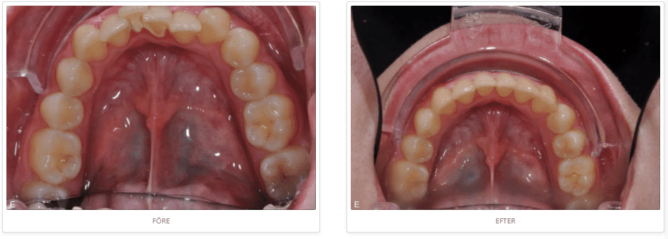 Invisalign-osynlig-tandstallning-before-after-2