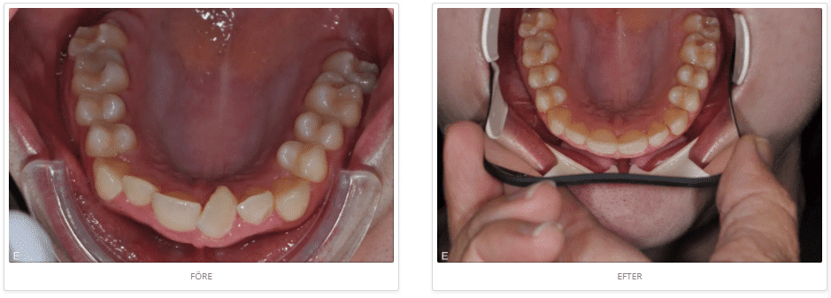 Invisalign-osynlig-tandstallning-before-after-3