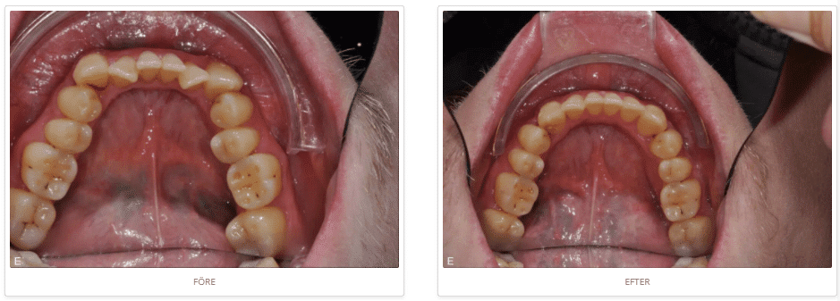 Invisalign-osynlig-tandstallning-before-after-4