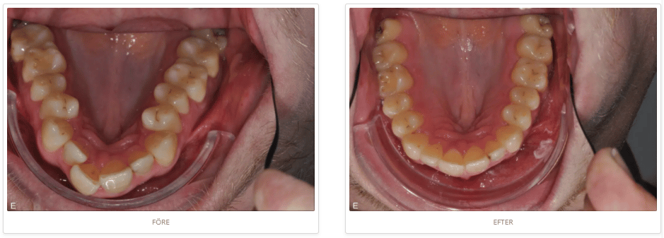 Invisalign-osynlig-tandstallning-before-after-5