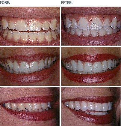 Tandblekning på kliniken med perfekt resultat/ före efter/Astondental