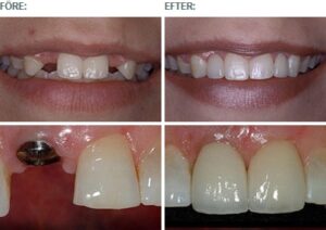Before and after pictures Dental implants Astondental