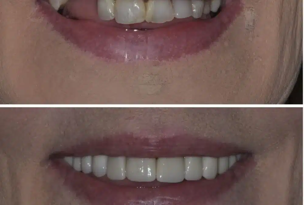 This picture shows the before and after of dental implants.